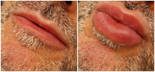 Aumento de labios - Les Rochas Clinic