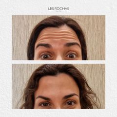 Eliminación de  arrugas - Les Rochas Clinic