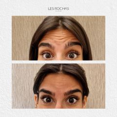 Eliminacion de  arrugas - Les Rochas Clinic
