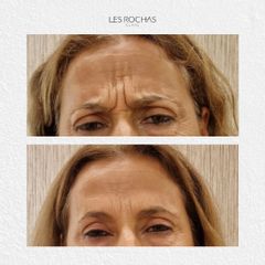 Eliminación de  arrugas - Les Rochas Clinic