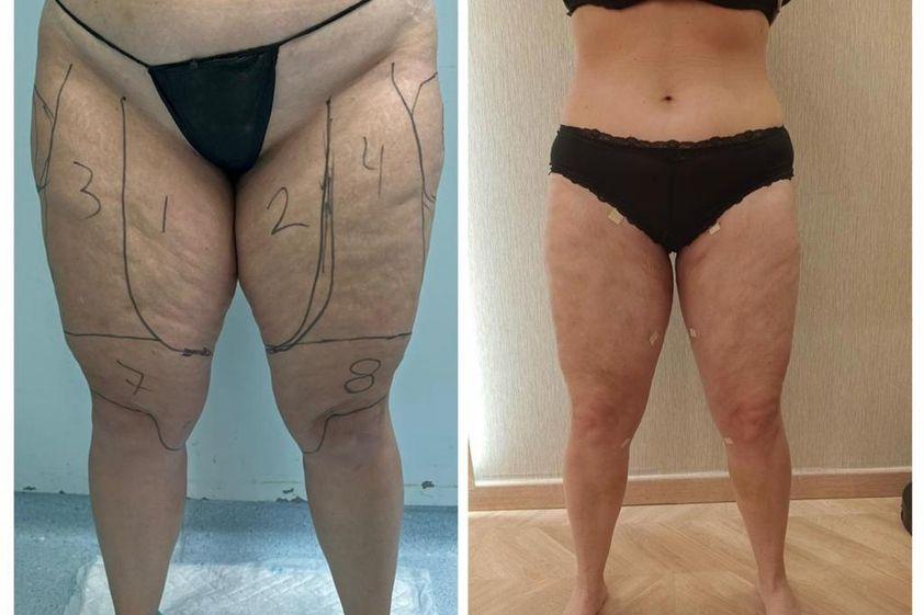 Lipedema antes y después - 864744