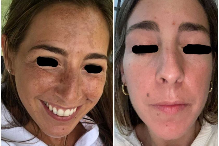 Peeling antes y después - 864747