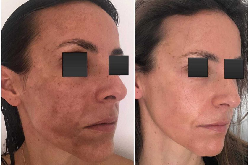 Peeling antes y después - 864748