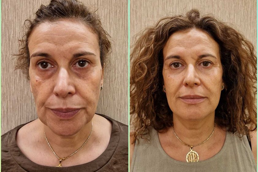 Hilos tensores antes y después - 869215