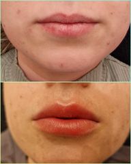 Aumento labios - Les Rochas Clinic