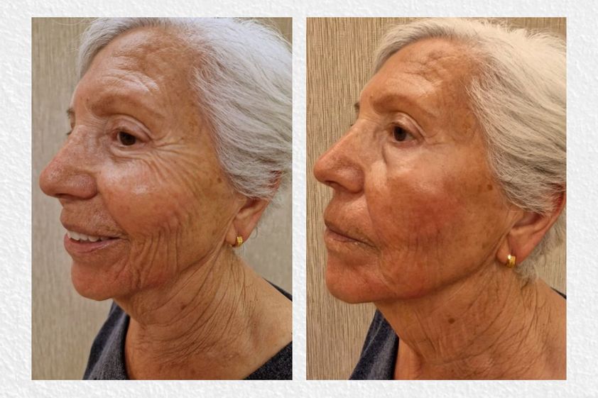 Lifting antes y después - 869217
