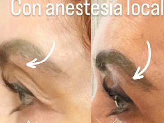 Blefaroplastia antes y después - 869275