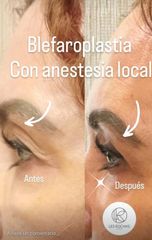 Blefaroplastia - Les Rochas Clinic