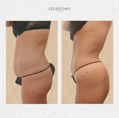 Lipo con bodytite - Les Rochas Clinic