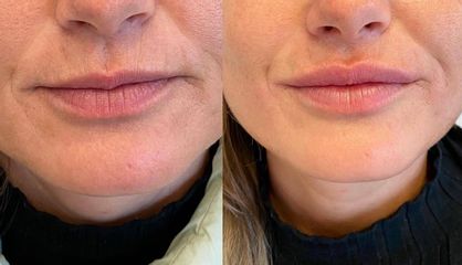 Aumento de labios - Dra. Denisa Bangean