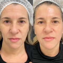 Radiofrecuencia facial - Dra. Denisa Bangean