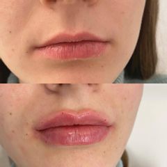 Aumento de labios - Dra. Denisa Bangean