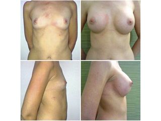 Antes y después aumento de mamas