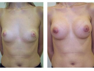 Antes y después Mamoplastia de aumento