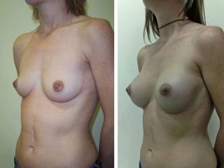 Antes y después Mamoplastia de aumento