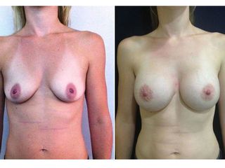 Antes y después Mamoplastia de aumento