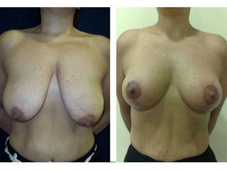 Antes y después Mastopexia