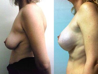 Antes y después Mastopexia