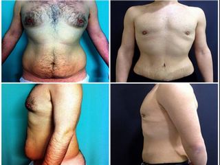 Antes y después Abdominoplastia y ginecomastia