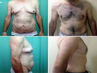 Antes y después cirugía combinada mamas y abdomen