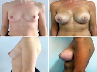 Antes y después Mamoplastia de aumento