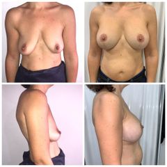 Antes y después Mastopexia con implantes