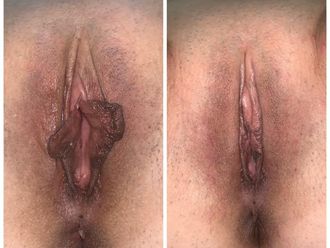 Vaginoplastia antes y después - 649820