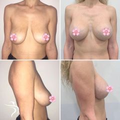 Antes y después Mastopexia - Dr. Sergio Morral