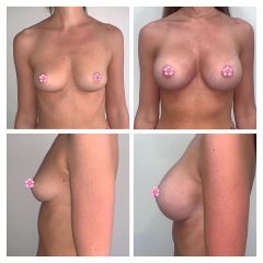 Antes y después Aumento de pecho - Dr. Sergio Morral