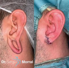 Antes y después Lobuloplastia - Dr. Sergio Morral
