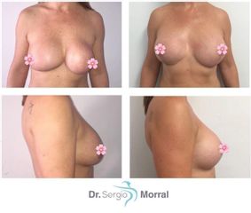 Antes y después Mastopexia - Dr. Sergio Morral