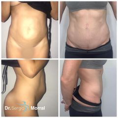 Antes y después Abdominoplastia - Dr. Sergio Morral