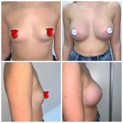 Antes y después Aumento de pecho - Dr. Sergio Morral