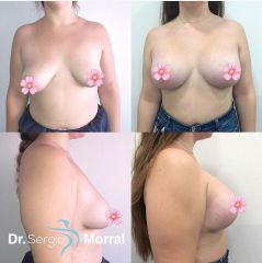 Antes y después Mastopexia - Dr. Sergio Morral