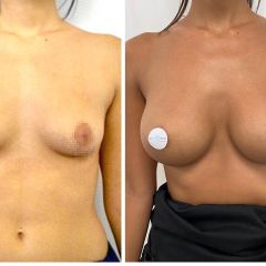 Antes y después Aumento de pecho - Dr. Sergio Morral