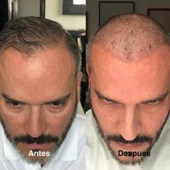 Antes y después Tratamiento capilar - Dr. Sergio Morral