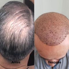 Antes y después Tratamiento capilar - Dr. Sergio Morral