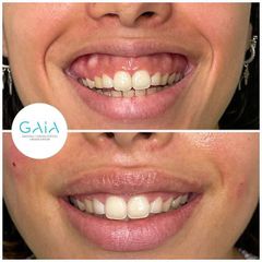 Sonrisa gingival ácido hialurónico Clínica Gaia