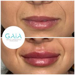 Aumento de labios - Clínica Gaia
