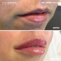 Aumento de labios - CCM Estética