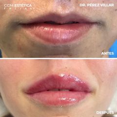 Aumento de labios - CCM Estética