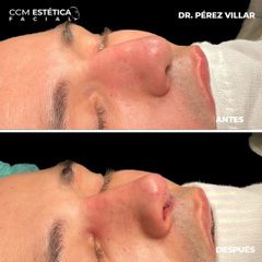 Rinoplastia - CCM Estética