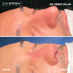 Rinoplastia - CCM Estética