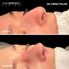 Rinoplastia - CCM Estética