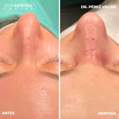 Rinoplastia - CCM Estética