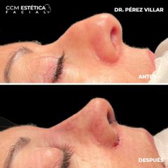 Rinoplastia - CCM Estética