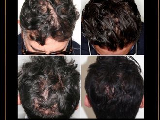 Tratamiento capilar antes y después - 876994