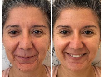 Rejuvenecimiento facial antes y después - 876995