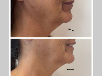 Rejuvenecimiento facial antes y después - 876996