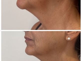 Rejuvenecimiento facial antes y después - 876997